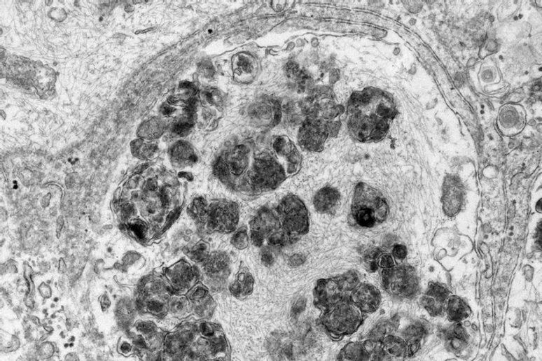 La formazione dei corpi di Lewy all 'interno dei neuroni (fonte:&nbsp;Armin Bayati from Peter McPherson Lab, The Neuro) - RIPRODUZIONE RISERVATA